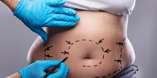 abdominoplastia con Fonasa