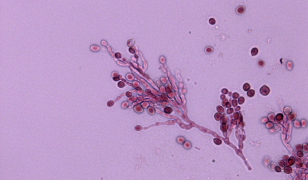 Aspergilosis