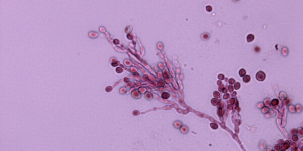 Aspergilosis
