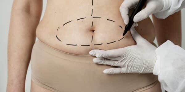 paso a paso cómo postular bono PAD abdominoplastia Fonasa