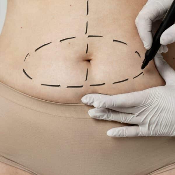 paso a paso cómo postular bono PAD abdominoplastia Fonasa