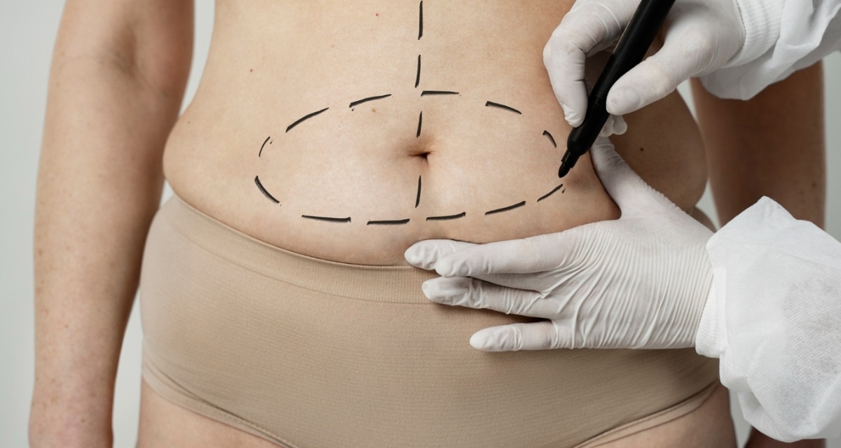 paso a paso cómo postular bono PAD abdominoplastia Fonasa