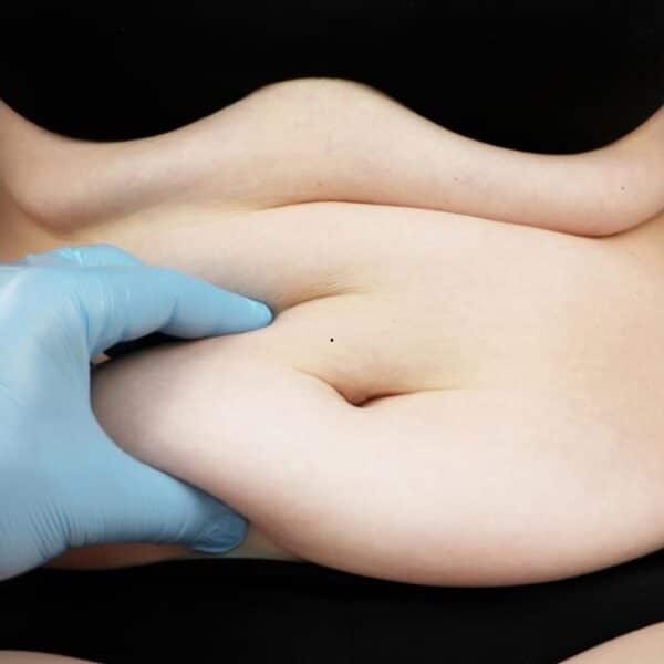 Una persona es atendida por un profesional de la salud en una sucursal de Fonasa, en el contexto del Bono PAD para el tratamiento quirúrgico del abdomen flácido.