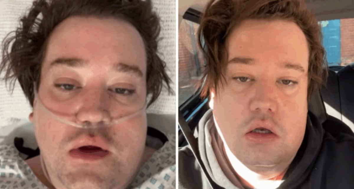 Nicolás Yunge, ex integrante de Perla, contó que estuvo en coma inducido en la UCI de un hospital de Londres tras una complicación por un quiste en la mandíbula